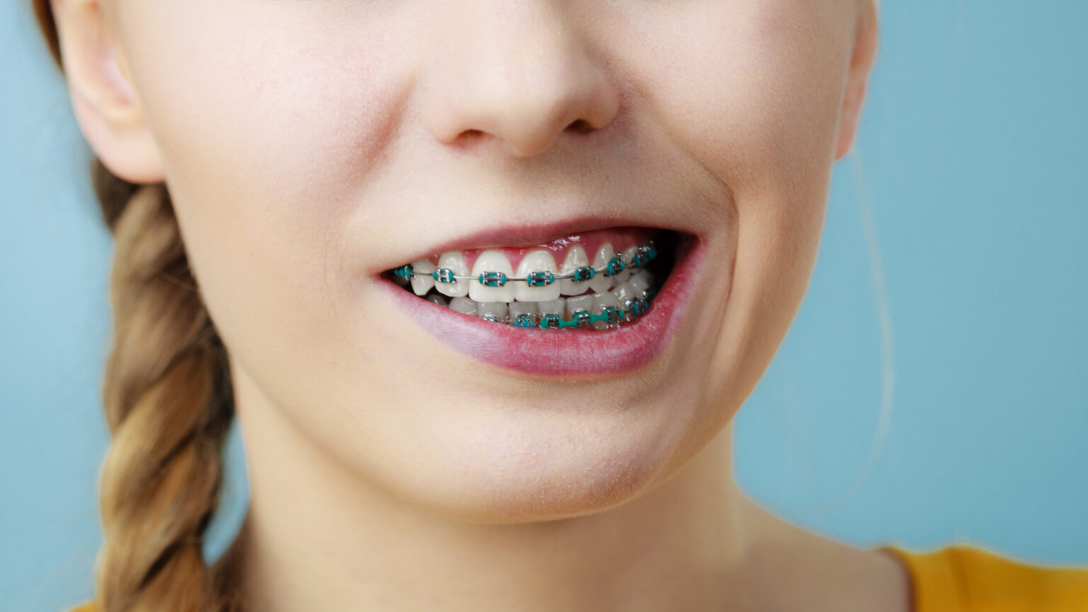 Clear Braces vs. Metal Which Should You Choose The Braces Guide