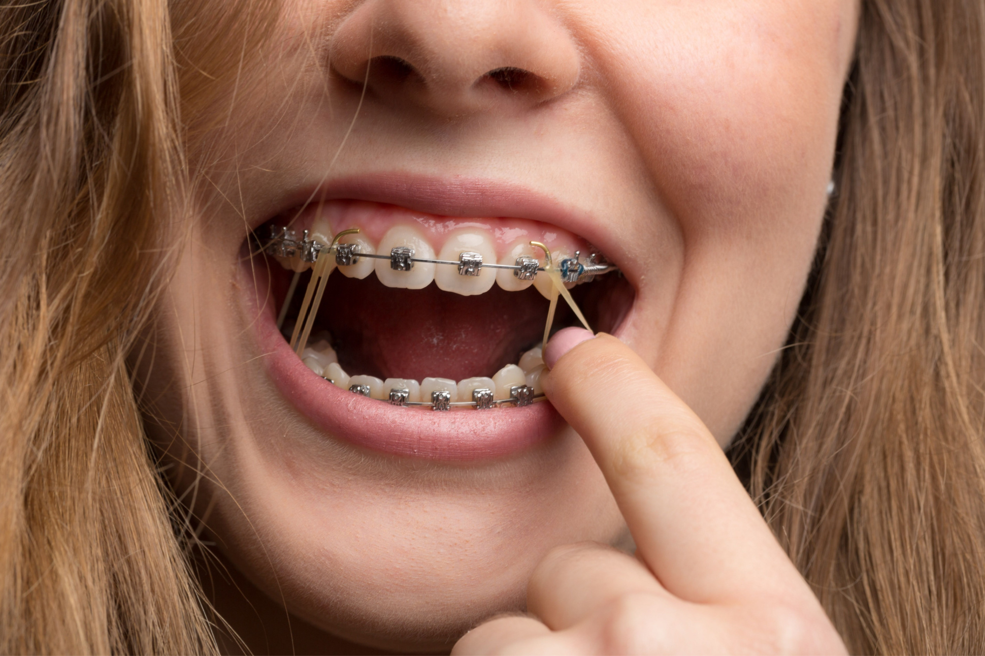 Braces Rubber Bands (Elastics) Everything You Need to Know The Braces Guide
