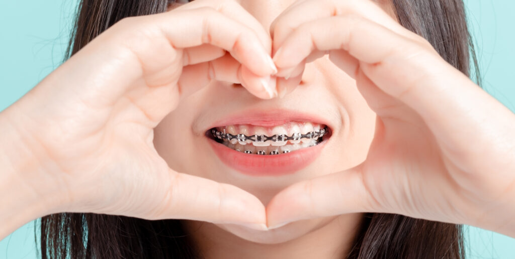 Closing Gaps With Braces Everything You Need to Know The Braces Guide