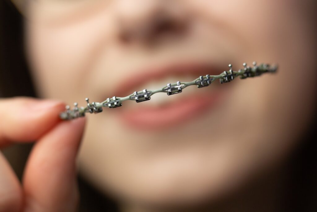 Power Chains for Braces Everything You Need To Know The Braces Guide