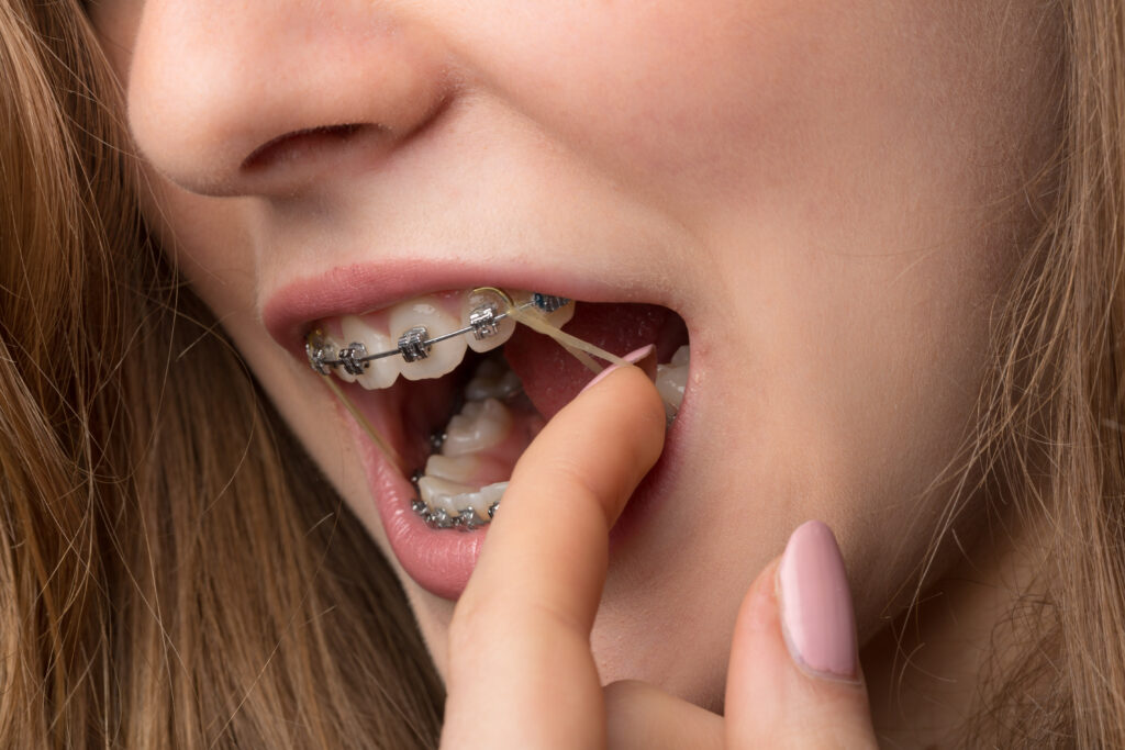 How Often Should You Change Your Braces Elastics? The Braces Guide