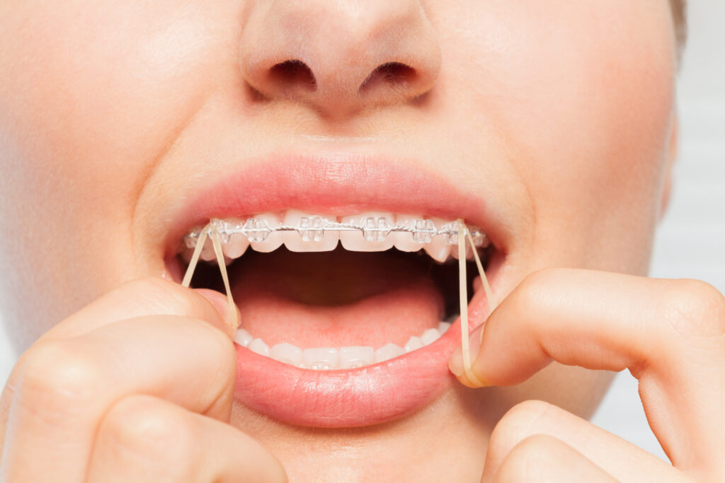 Braces Rubber Bands Elastics Everything You Need To Know The