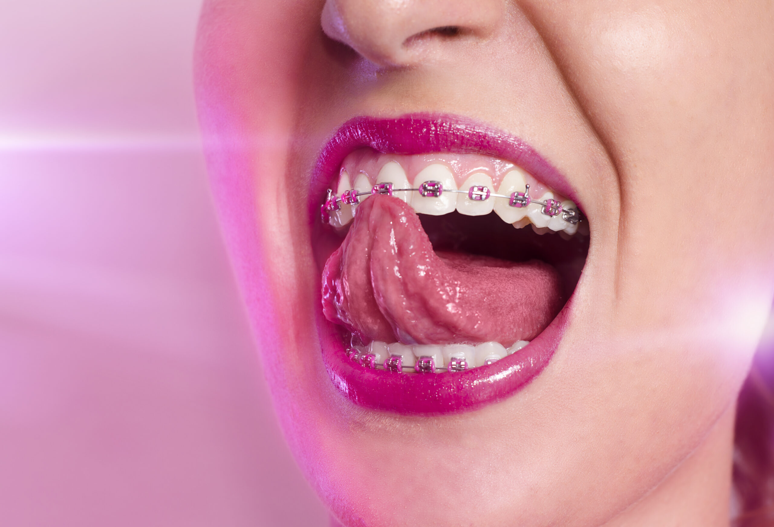 Can You Give a Blowjob with Braces? - The Braces Guide