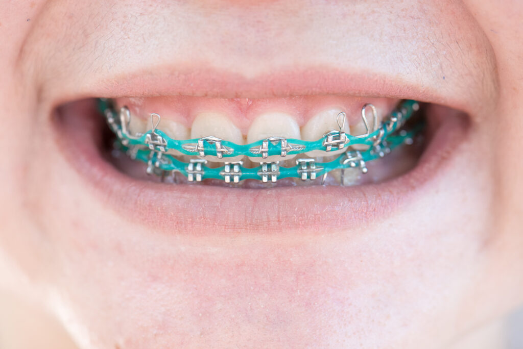 Is Teal a Good Color for Braces? The Braces Guide