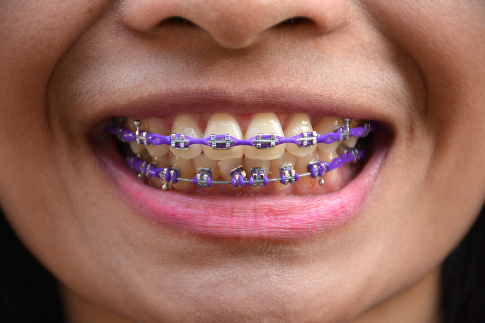 Is Purple a Good Color for Braces? The Braces Guide